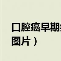 口腔癌早期症状图片 特征（口腔癌早期症状图片）